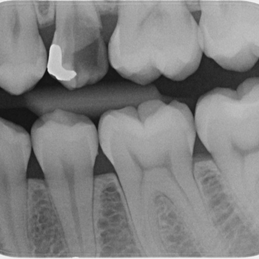 Chir. extruze, RCT, korunka