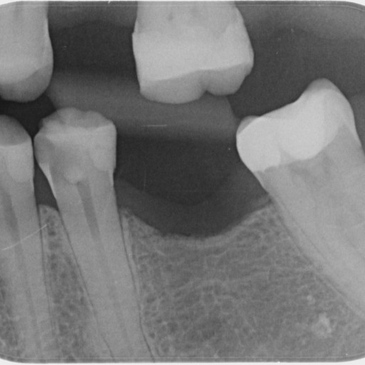 RCT + FRC čep